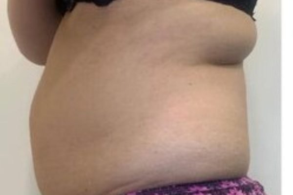 Cellulite-Treatment-before